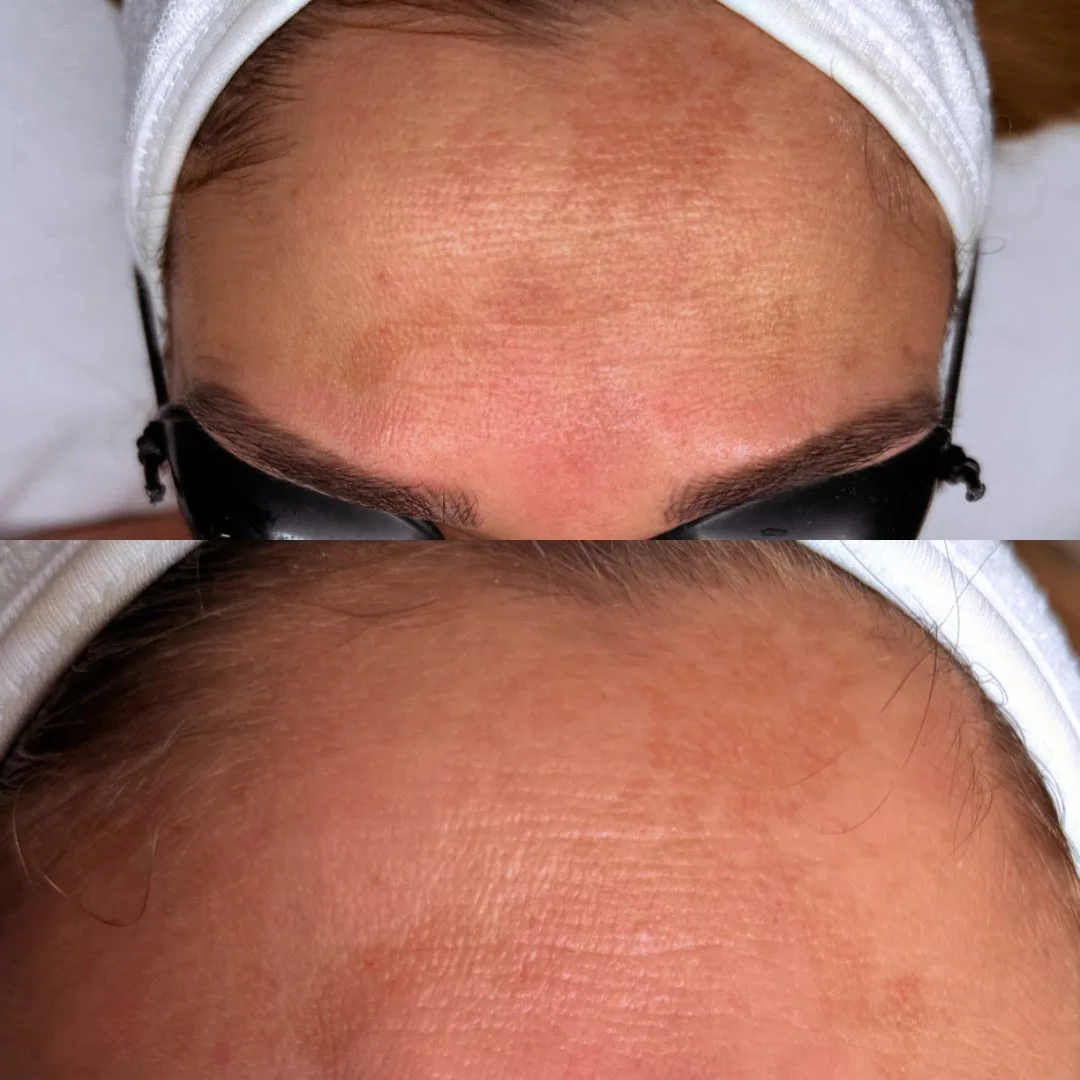 Antes y después de tratamiento para manchas faciales
